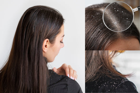 What is Dandruff and Why Does it Happen?