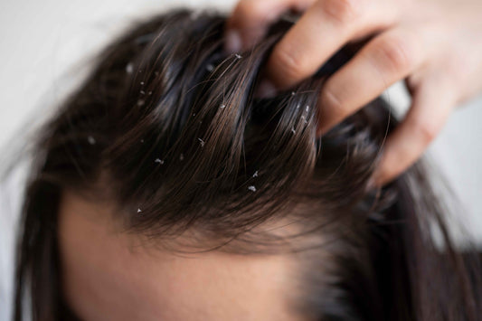 What is Dandruff and Why Does it Happen?